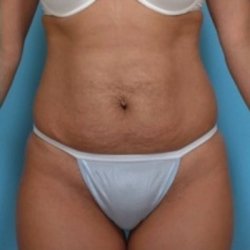 Manhattan abdominoplasty before 1